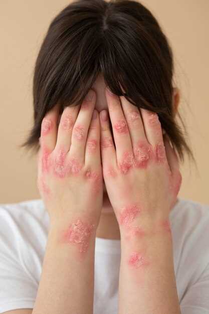 Naproxen eczema